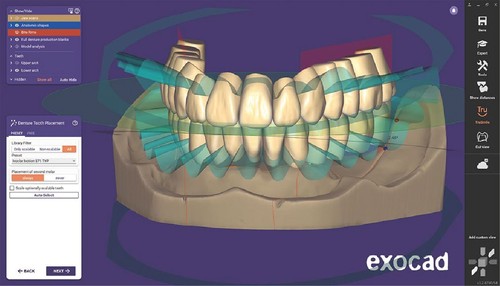 3shape exocad design - 3shape, kronen
