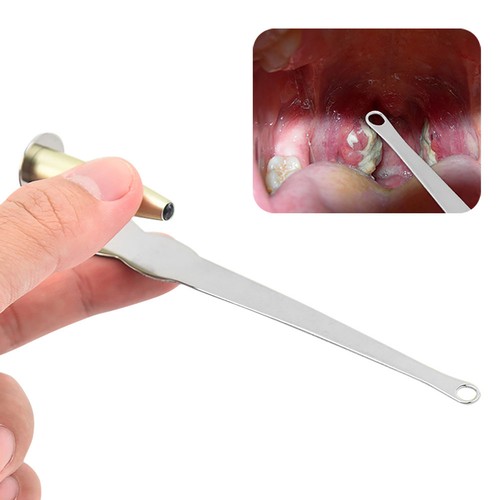 Tonsil stone - tonsil,