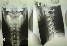 12 tlg. Röntgenbilder Set, Original Roentgenfilme 12 St. - u.a. Hüfte, Hände HWS