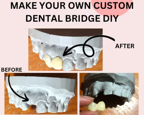 Zahnbrücke diy custom - zahnbrücke,
