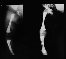 RÖNTGEN GEBROCHENER /