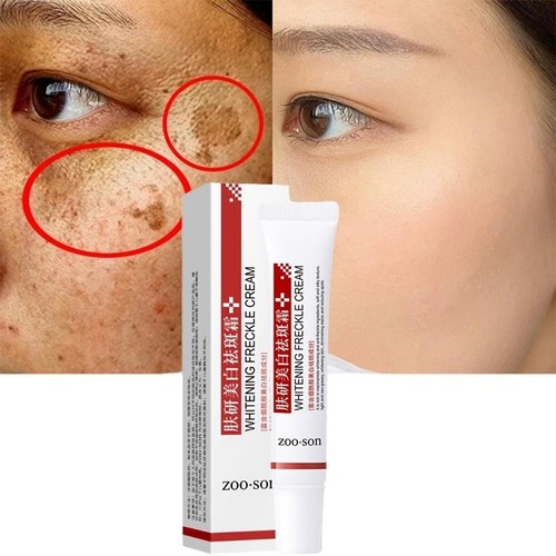Whitening sommersprossen creme - sommersprossen,