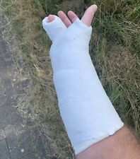 Gipsarm SAFS Weissgips rechts