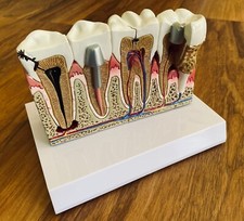 Zahnmodell Zahnerkrankungen