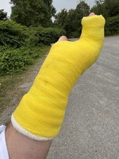 Gipsarm SAFS links Kunststoffgips creme 4 Wochen getragen