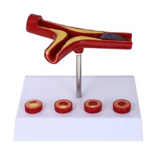 Atherosklerose Anatomisches