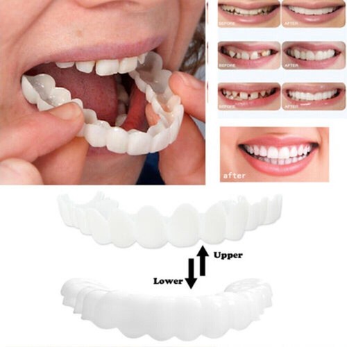 Snap veneers kosmetische - on,