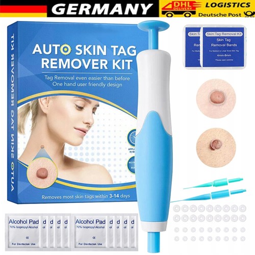 Stielwarzen entferner skin - entferner,
